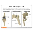 Implant Mini-implant Joint Set Of 3 Gpi Lfa  1910  Make Us An Offer  See Video