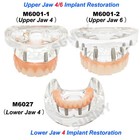 Dental Upper lower 4 6 Implants Demo Implant Teeth Model Restoration Overdenture