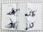 1850s Antique Medical Lithograph Plate Hip Dislocation Luxation Anatomy Fabbri