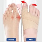 2pcs Big Toe Bunion Corrector Splint Straightener Foot Pain Relief Hallux Valgus