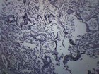 Pneumonia In Human Lungs - Prepared Slide - 75x25mm - Eisco Labs