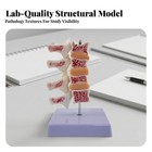 Osteoporosis Spine Model Pvc For Classroom  Doctors