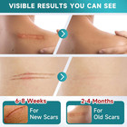 Silicone Scar Sheets  Silicone Scar Tape For Surgical Scars  3m