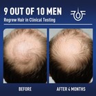 5  Minoxidil Hair Growth With Biotin  Minoxidil For Men And Women - Hair Grow   