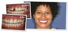 Temporary Teeth Tooth Repair Kit   Cosmetic Repair   30 Teeth  It Really Works 