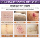 Silicone Scar Sheets Scar Removal Strips Tape 1 6   x59   