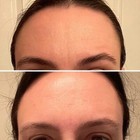 Frownies Facial Patches For Forehead   Between Eyes  Smooths Fine Wrinkles 144c