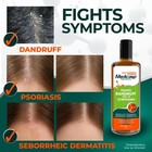 Medicasp Coal Tar Anti-dandruff Shampoo  Flakes Shampoo  6 Fl Oz  2 Pk