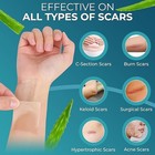 Scar Removal Silicone Tape For Hypertrophic Scars   Keloids  1 6   X 150  