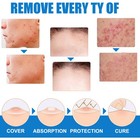 Professional Wart And Skin Tag Remover Cream Topical Skin Repair Treatments