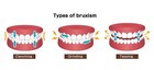 Custom Made Dental Night Guard - Usa Dental Lab  Fda Approved Materials 
