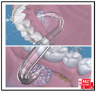 Professional Replacement Tips For Waterpik Water Flosser - 6 Implant Denture Tip