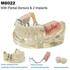 Dental Typodont Restoration Teeth Model With Partial Dentures 2 Implants Demo
