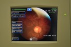 Nidek Handy Nm-200d Non-mydriatic Fundus Camera