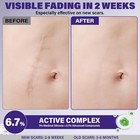 Silicone Scar Gel  Advanced Scar Cream For Burns   Acne Scars Away  Stretch Mark