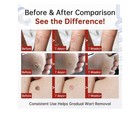 20  Salicylic Acid Wart Remover Liquid  Extra Strength Plantar Wart Remover