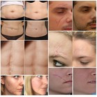 Scar Repair Cream For Face   Body Treat Heal Scars Stretch Marks Acne Repair