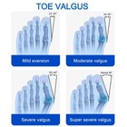 Bunion Corrector Big Toe Straightener Hallux Valgus Orthotics Foot Pain Relief