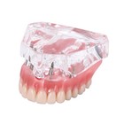 Dental Implant Teeth Model Demo Overdenture Restoration With 4 Implants Upper