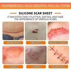 Silicone Scar Sheets  1 6 x60  Roll-1 5m  Silicone Scar Tape For Surgical Scar