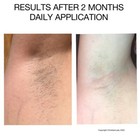 Hair Removal-permanent Hair Reduction inhibition  Back  Legs  Chest  Face-2 Oz