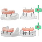 Dental 4 Implants Upper lower Demo Implant Teeth Model Restoration Overdenture