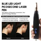 Picosecond Pico Second Laser Beauty Machine Tattoo Pigment Removal Pen Us