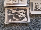 Three Antique Medical Photographs Skin Disease Dermatology