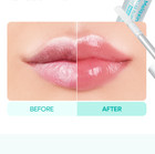 Dr melaxin Bp Spicule Plumping Lip Shot 2 Type