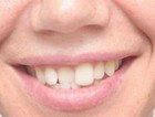 Relapse Orthodontic Treatment - Active Retainer Upper Or Lower  made In Usa 