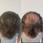 Hair Building Fibers Refill Medium Brown 25g Follic Tech Highest Quality On Ebay