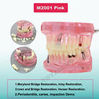 Dental Typodont Teeth Model Ortho Overdenture Implant Practice Demo Study Model
