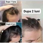 Hair Loss Shampoo And Lotion
