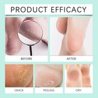 40  Urea Foot Cream With 2  Salicylic Acid For Dry Cracked Feet  100g