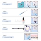 Dental Orthodontic Light Cure Bracket Braces Glue Bonding Resin etching Gel