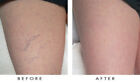 Lux Vitamin K Cream - Eliminate Spider Varicose Veins Scars Rosacea Capillaries