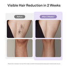 Ulike Air 10 Series Ipl Laser Hair Removal Ice-cooling Smart Skinsensor For Body