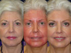 Pure Glycolic Acid 70  Strength - Beautiful Glowing Skin Fast