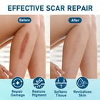 Silicone Scar Sheets Medical Grade Silicone Tape Strips For Hypertrophic Scars