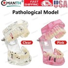 Us Dental Teeth Model Implant Periodontal Disease Suture Drilling Training Demo