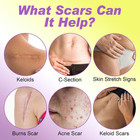 Silicone Scar Sheets Roll - 1 6  X 120  Silicone Scar Tape