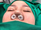 D Type 8 3 1 5cm With Tube Merocel Sinus Nasal Pack Hemostatic Pva 20pcs