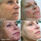 Resurfacing Chemical Peel 90  Acid Concentrated Formula Must Dilute  30ml