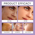1 5 Pack Epiglow Melanex Advanced Anti-hyperpigmentation Cream