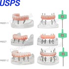 Us Dental Implant Model Overdenture Upper Lower Jaw 4 6 Screws Post Core Bridges