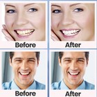 28pcs 5d Teeth Whitening Strips Tooth Rapid Bleaching White Strips Teeth White