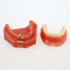 Dental 2 Implants Model Overdenture Removable Lower Jaw 2 Ball Locator Demo
