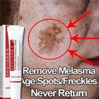Powerful Spot-removing Whiten Cream Pigmentation Melasma Dark Spots Free Ship