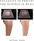 Ashley Black Fasciablaster Trigger Point Fascia Tool For Recovery Anti-cellulite