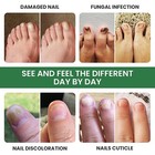  the Latest     Nail Fungal Lacquer 2 5ml Free   Fast Shipping